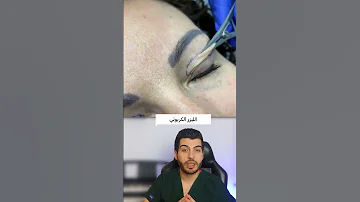 جراحة تجميلية للجفن جراحة تجميلية تجميل الجفون الليزر الكربوني Microneedling Laserco2 د مصعب حسوا 