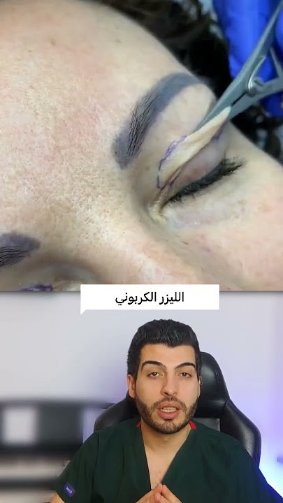 جراحة تجميلية للجفن #جراحة_تجميلية#تجميل_الجفون #الليزر_الكربوني#microneedling #laserco2#د_مصعب_حسوا