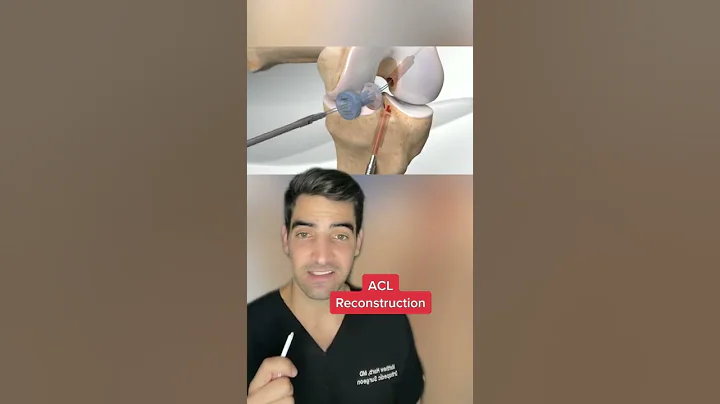 ACL Reconstruction