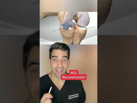 Видео: Как да рехабилитирате коляното си след операция ACL (със снимки)