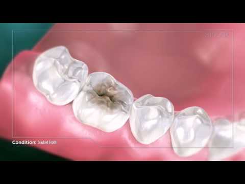 Video: Doare un dinte crăpat?