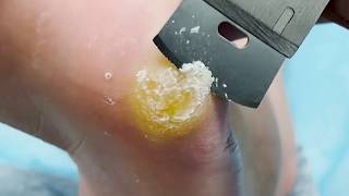 How to get a clean foot?