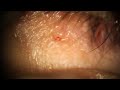 Popping eye milia seed and cyst in one squeeze