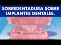 Sobredentadura sobre implantes dentales ©