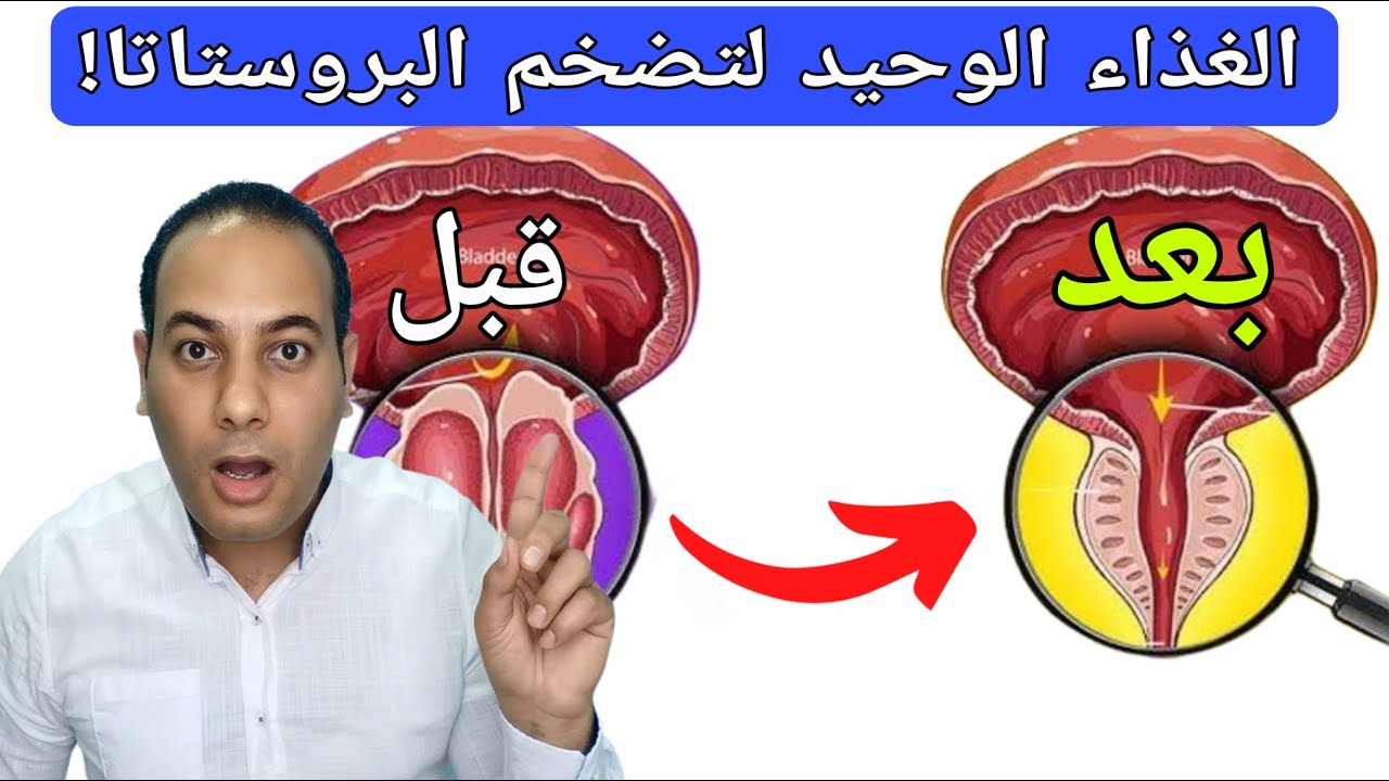 الغذاء الوحيد لتصغير البروستاتا المتضخمه مهما كان حجمها/اهم عنصر غذائي لتصغير البروستاتا!