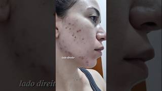 Resultado De 2 Meses Usando Acnezil