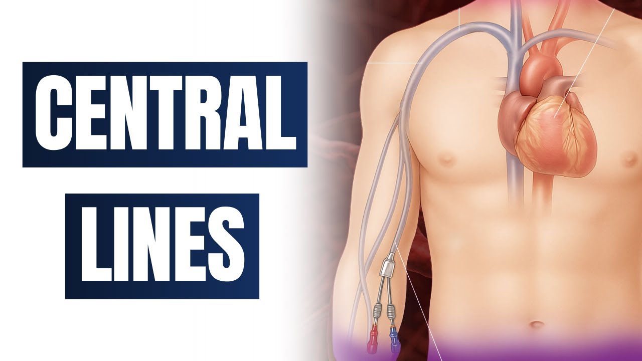 What You Need to Know About Central Lines