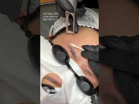 Video TATTOO REMOVAL IN TIME-LAPSE - Hút Mực Xăm Công Nghệ... - youtube