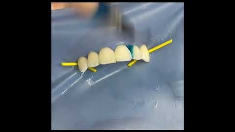 Bioclear- Black Triangle closure