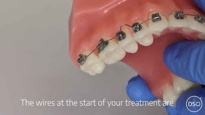 How to Handle Pokey Wires and Home and Other Orthodontic Tips - Belmar  Orthodontics