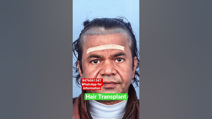 Rajpal Yadav 10 Month Hair Transplant Result| WhatsApp Guidance 8476061347