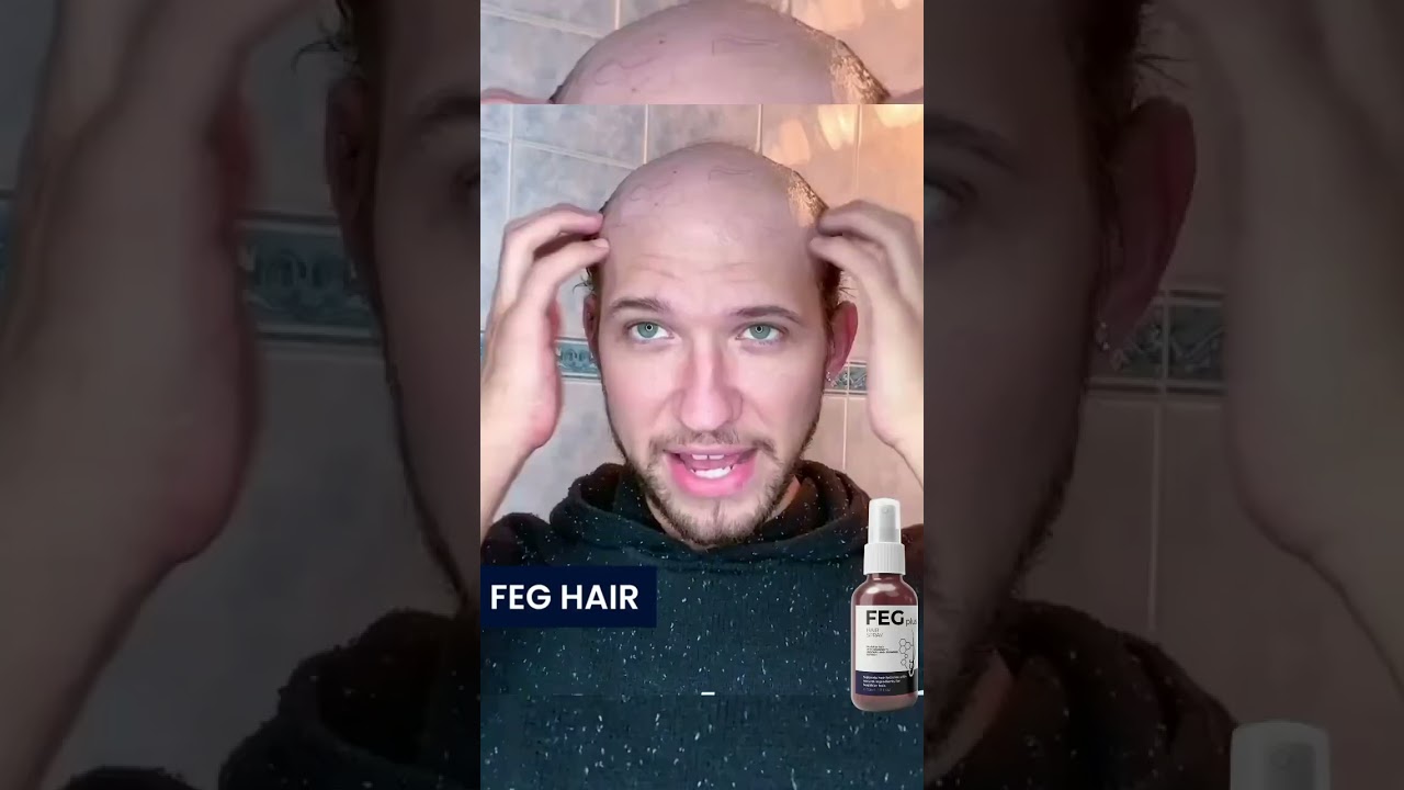 Using FEG Plus Hair too much, had to shave head. Buy one get one free, link in bio