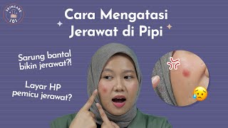 Penyebab Jerawat di Pipi dan Cara Mengatasinya | Skincare 101