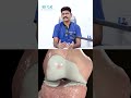 Knee arthritis symptoms telugu | Dr Prakash Gudipudi | #kneepain #kneearthritis #kneepainrelief