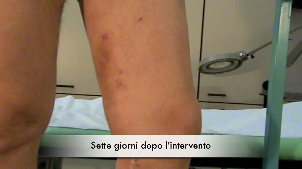 Legatura E Stripping Di Vene Varicose Dell Arto Inferiore Varici in un uomo , vene varicose stripping laser chiva veneinforma
