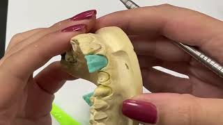 : maxillary central incisor wax-up