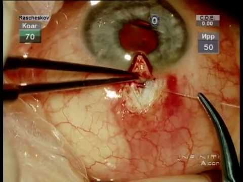 Видео: Склерално изкривяване: хирургия, подробности за процедурата и време за възстановяване