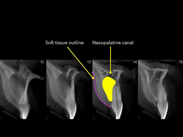 Neopalatial Nasopalatine Canal Unique Air Inclusions Within The Nasopalatine Duct