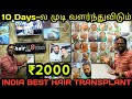 😱10 Days-ல முடி வளர்ந்துவிடும்🙄Hair Loss Solution💥PRP GFC Treatment Low Budget💥No Side Effects