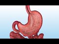 How is the Gastric Balloon Inserted and Removed?