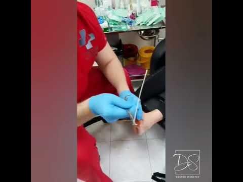 Вадене на игли след операция на ходилото - YouTube