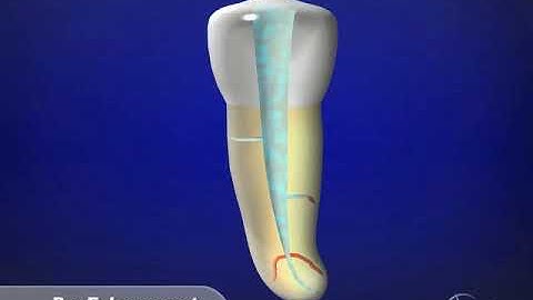 Shaping Preparation Sequence - Concepts & Strategies: Advanced Endodontics: Dr. Ruddle