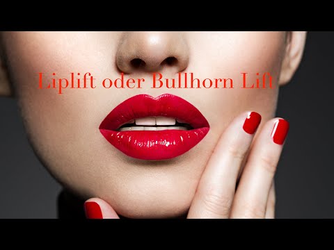 #Bullhorn Lift, #Liplift, Dr. Hohl erklärt