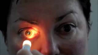 Miller Fisher Syndrome From Infliximab