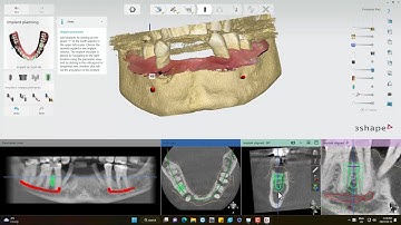 Trying 3Shape Implant Studio