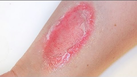 FX MAKEUP SERIES: Second Degree Burns