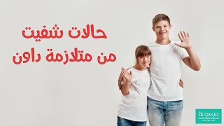 كيفية علاج متلازمة داون نهائيا