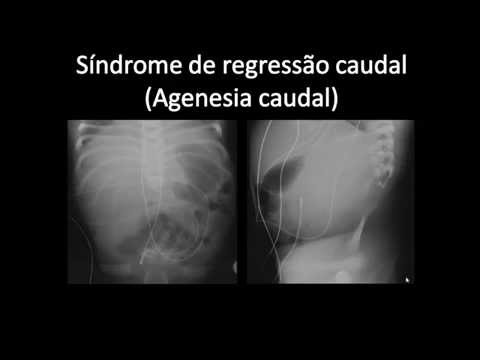 Vídeo: Síndrome De Regressão Caudal: Tipos, Causas E Muito Mais