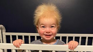 Baby Has Rare ‘Uncombable Hair Syndrome’