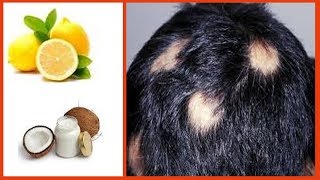 4 दिन में बालो का झड़ना बिल्कुल बन्द - How to Stop Hair Loss and Promote Hair Regrowth