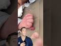 Doctor Reacts: born with an extra finger
