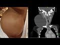 CERVICAL LYMPHANGIOMA