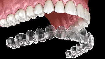 Niềng răng trong suốt Ocalign