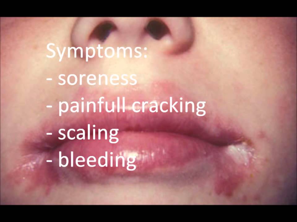 angular cheilitis cure