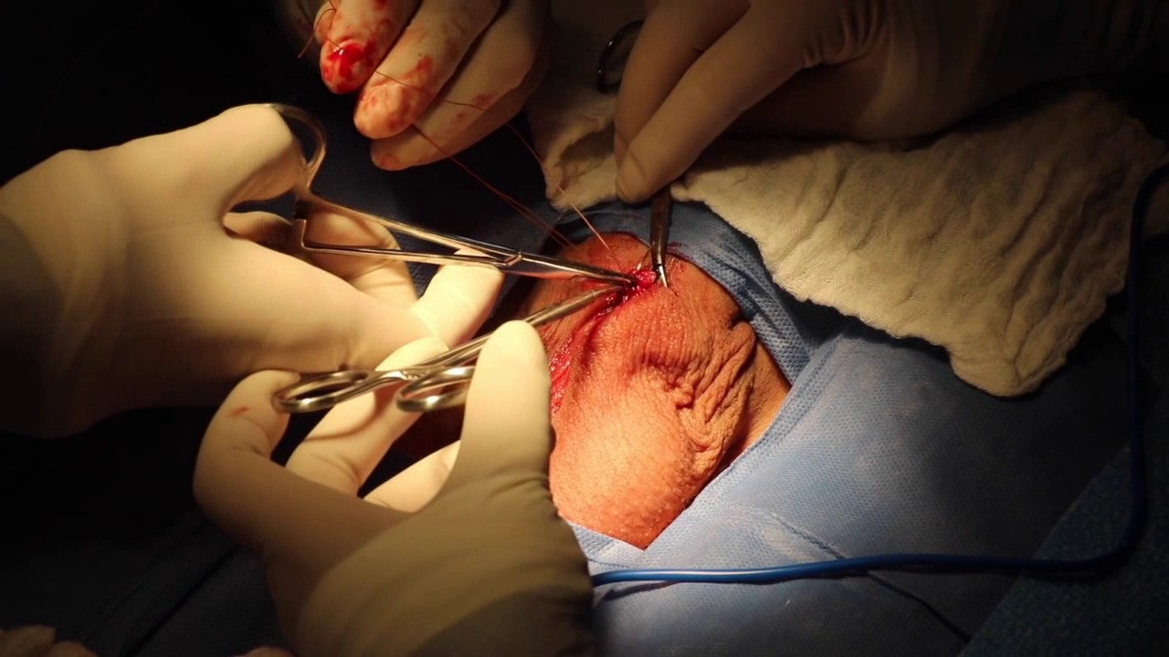 Cuanto Cuesta Hacerse La Vasectomia Vasectomía Parte II / Observe la cirugía - YouTube