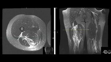 Hamstring muscle rupture