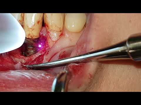 Laseri i njihova primjena u parodontologiji - kirurgija mekih tkiva pomoću diodnog lasera