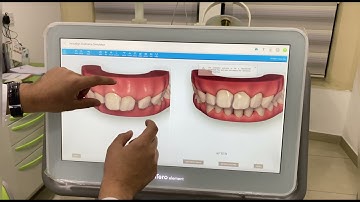 Tại Sao Nên Lựa Chọn Niềng Răng Trong Suốt Invisalign? 2021