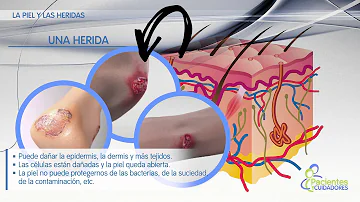 ¿Qué afecta negativamente a la cicatrización de las heridas?