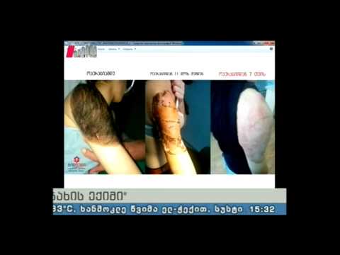 \"ოჯახის ექიმი\"  07.08.15  კანის კეთილთვისებიანი სიმსივნეები და   სხვა  ავთვისებიანი სიმსივნეები