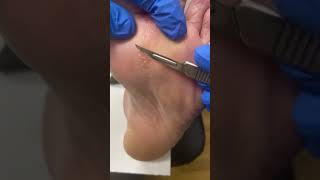 Discover Relief In Our Latest Forefoot Hard Corn Removal Video With Our Australian Podiatrist #Footc