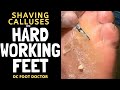 Hard Working Feet: Trimming Thick Calluses