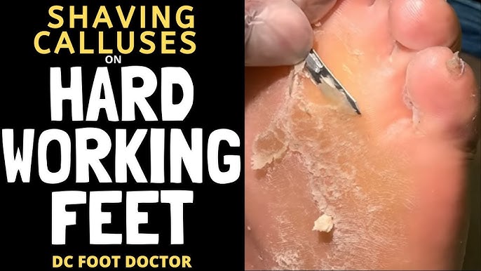 Satisfying hard skin on foot callus removal 