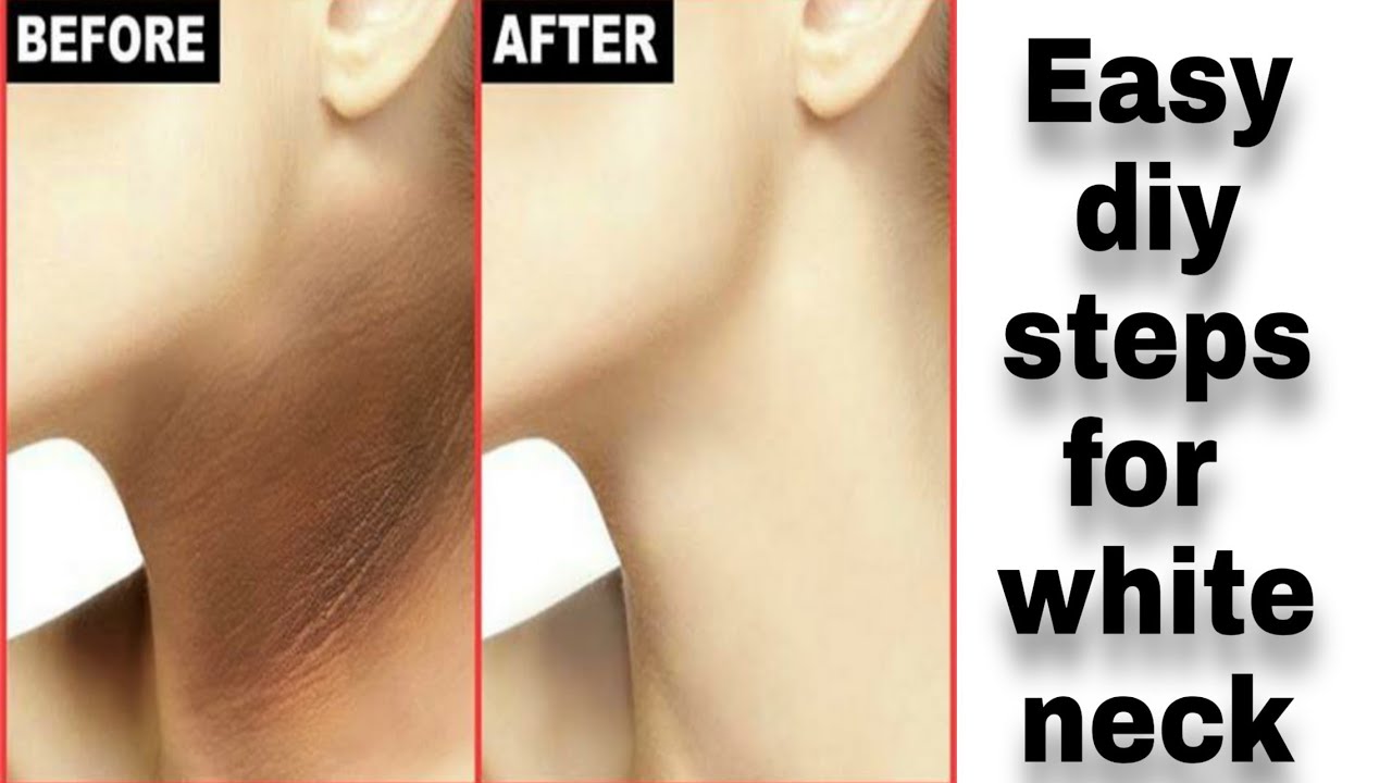 Best home remedies for dark neck.//Beauty with SONAM//😊 YouTube