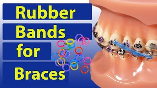 Rubber Bands (Elastics) for Braces - Braces Guide