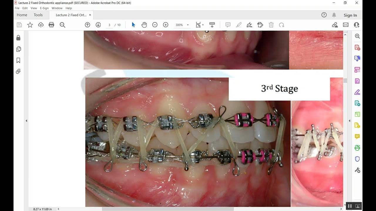 Fixed Orthodontic Appliances Part 5 YouTube
